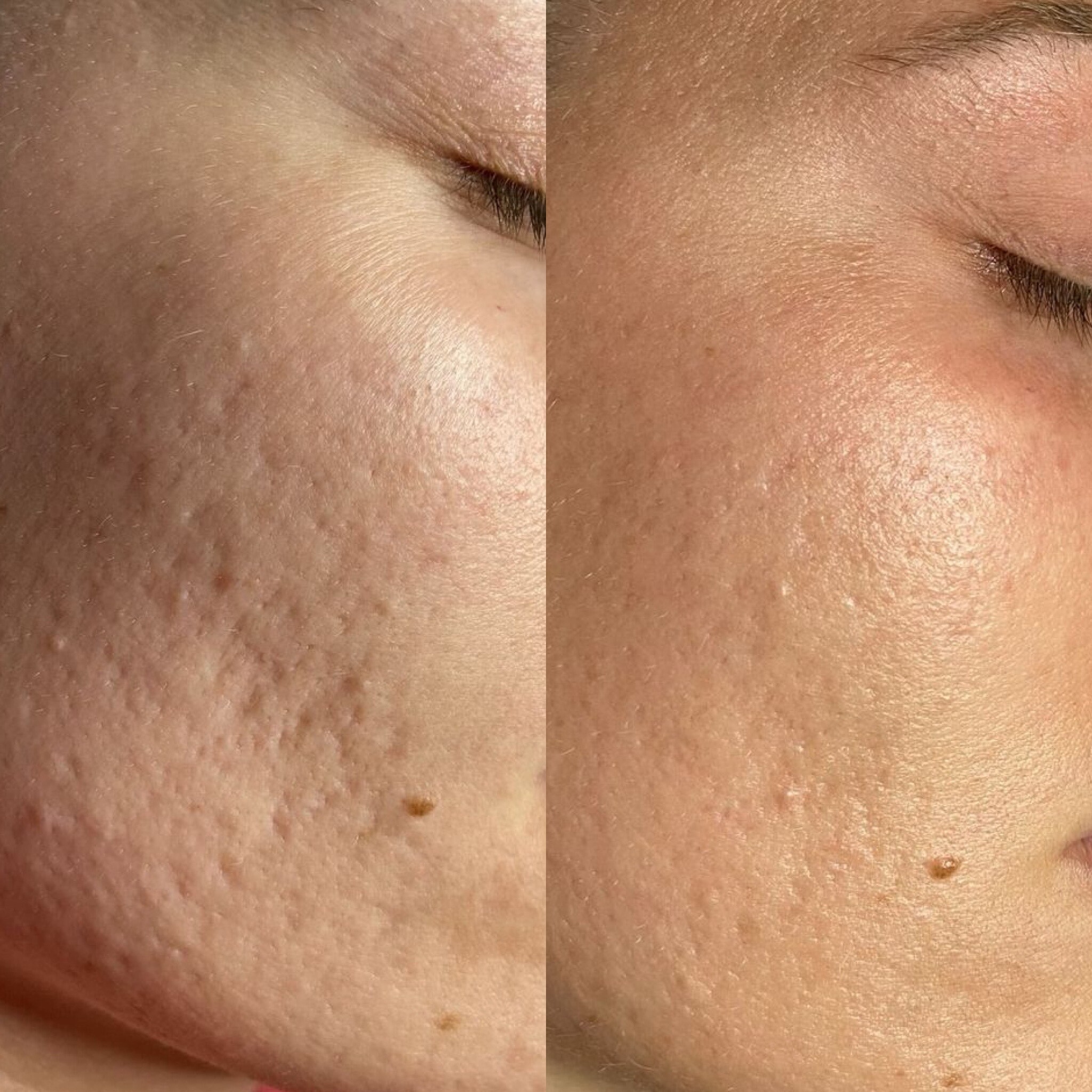 before and after photo showing skin improvements after SkinPen microneedling treatment at REVIVE